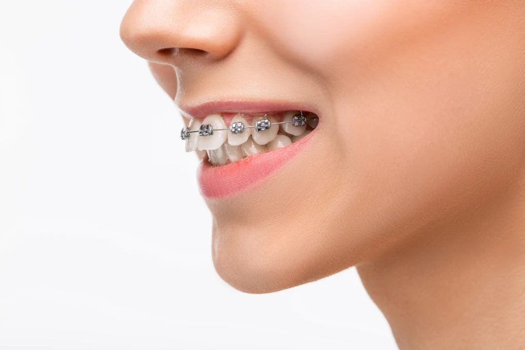 Ortodonție beautiful young woman with teeth braces